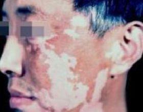 白癜风图片 白癜风图片