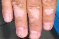 白癜风图片 白癜风图片