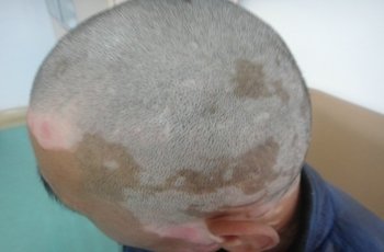 白癜风图片 白癜风图片